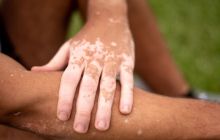 Белые пятна на коже: что это значит и как с ними бороться