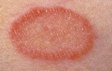 Чем лечить лишай у человека - лучшие средства