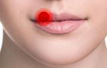 Чем лечить герпес на губе: эффективные мази от герпетической инфекции