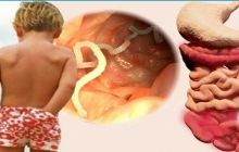 Лечение гельминтоза: как избавиться от глистов